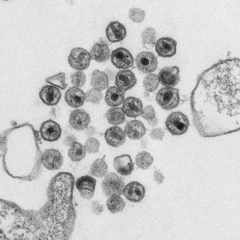 The novel drug causes the HIV capsid to rupture before it can deliver its genetic material to the host cell nucleus. Image: HIV particles; Public Health Image Library